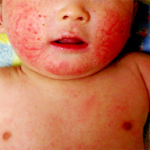 赤ちゃんのアレルギー