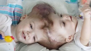 頭部が一緒になって生まれた双子の赤ちゃん